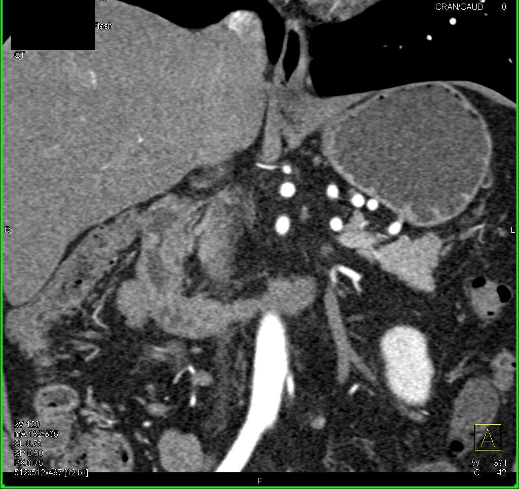 Duodenitis - CTisus CT Scan