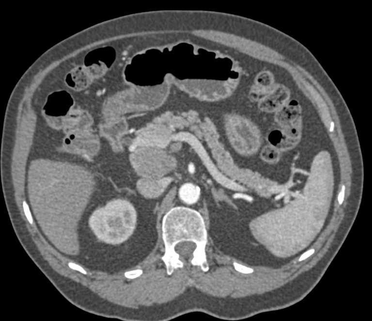 Duodenal Adenocarcinoma with Adenopathy - CTisus CT Scan