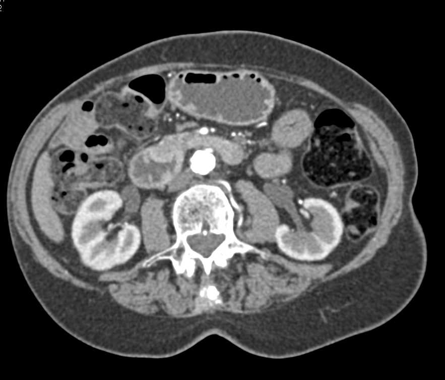 Duodenal Adenocarcinoma with Adenopathy - CTisus CT Scan