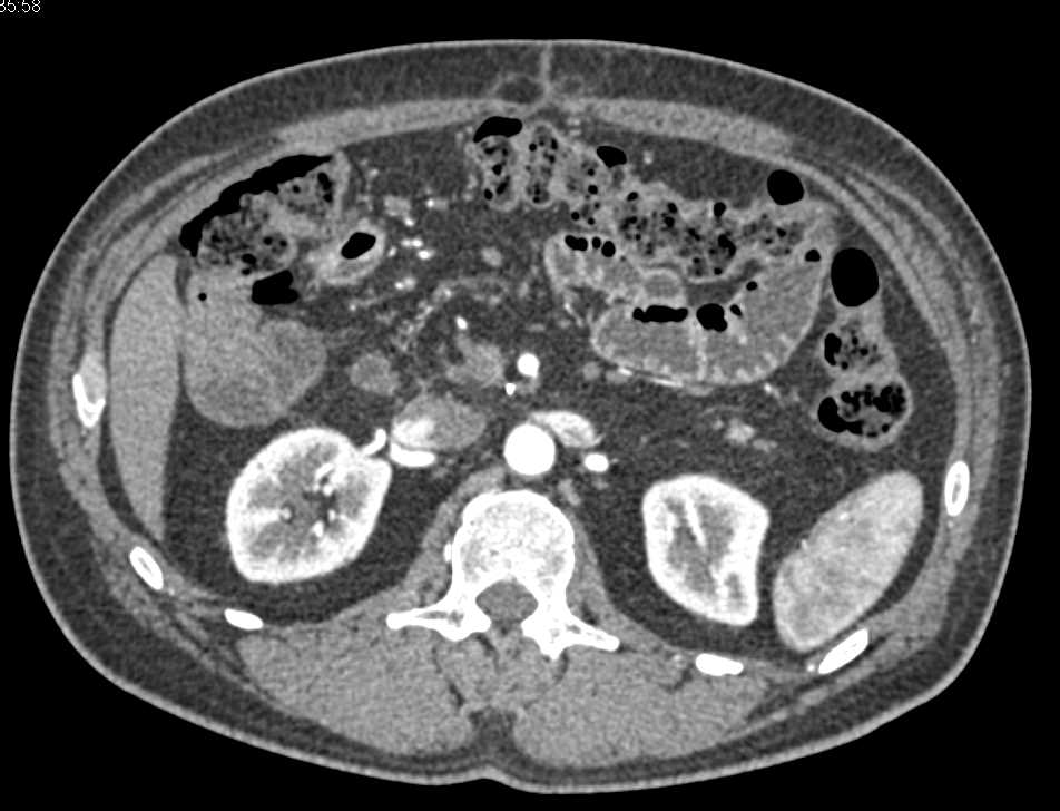 Duodenal Adenocarcinoma - CTisus CT Scan