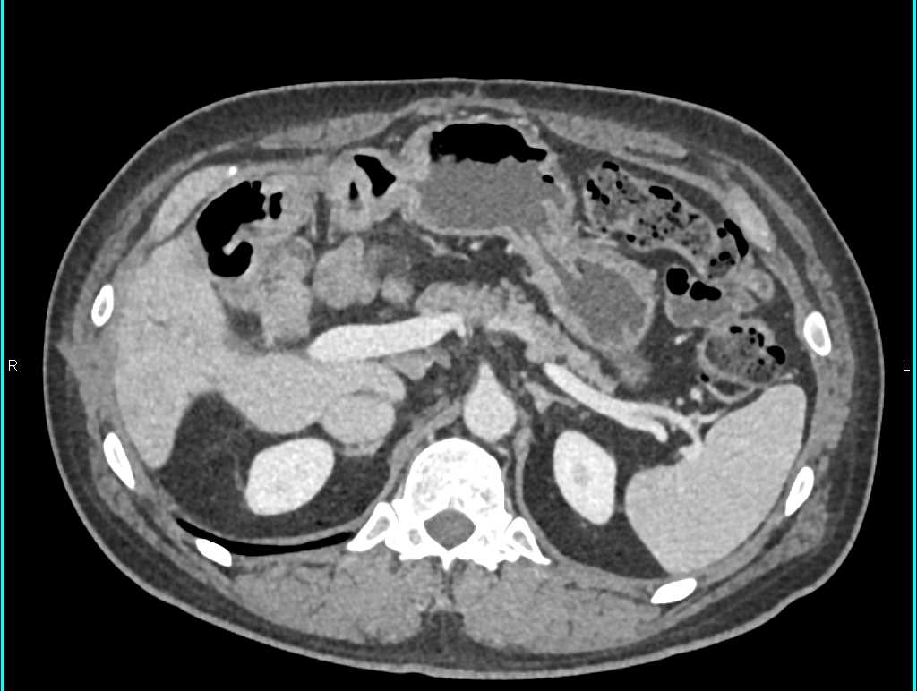 Duodenal Adenocarcinoma - CTisus CT Scan