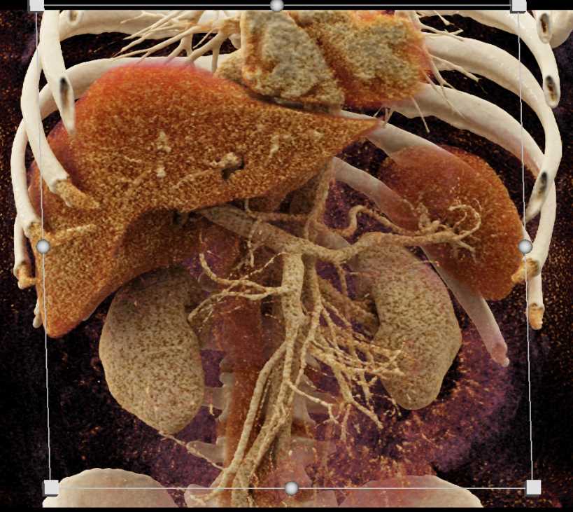 Duodenal Carcinoid Tumor - CTisus CT Scan