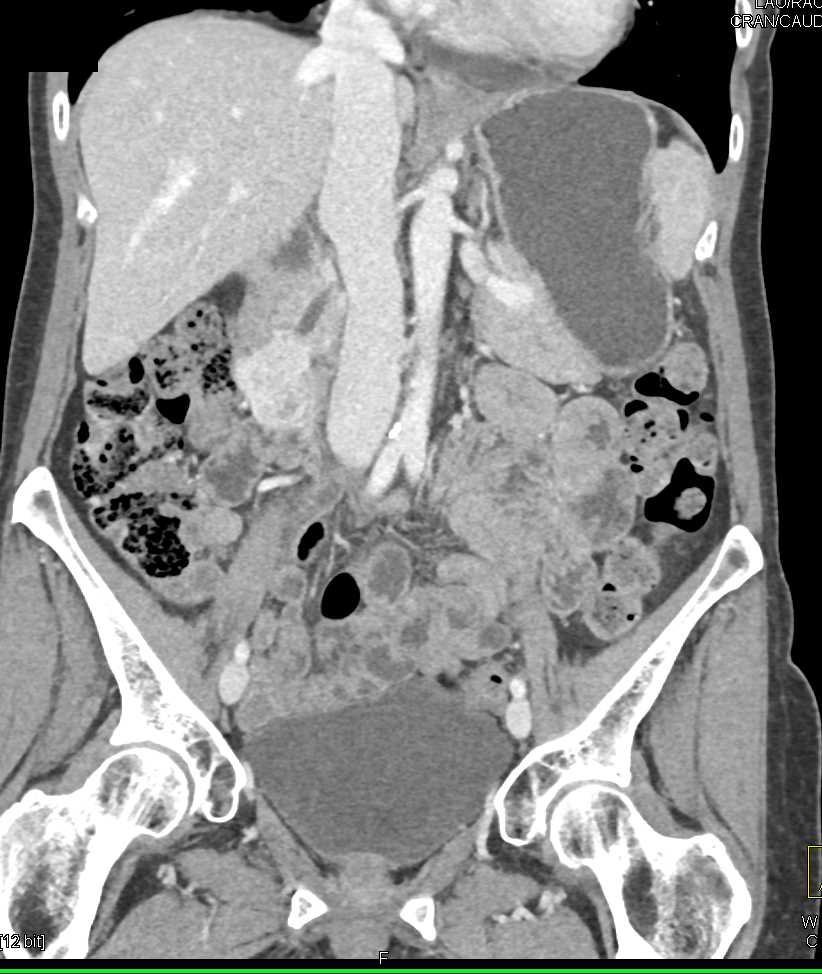 Duodenal Carcinoid Tumor - CTisus CT Scan