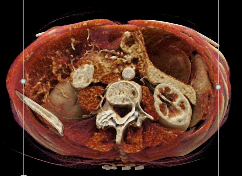 Duodenal Carcinoid Tumor - CTisus CT Scan