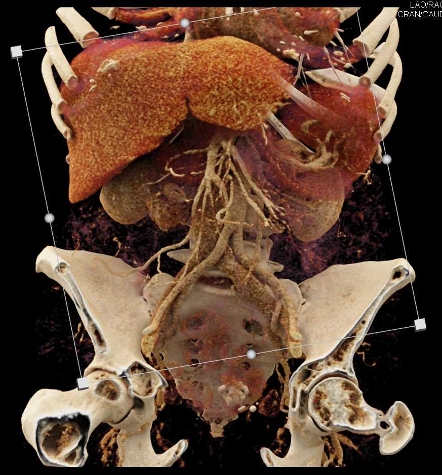 Duodenal Carcinoid Tumor - CTisus CT Scan