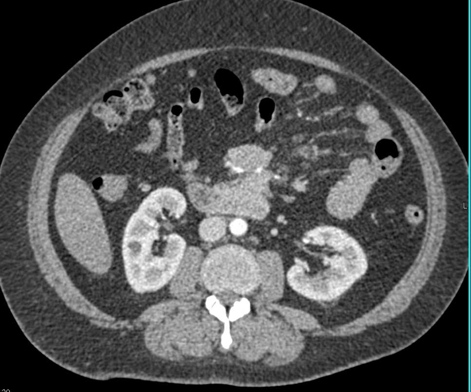 Carcinoid Tumor Fourth Portion Duodenum - CTisus CT Scan