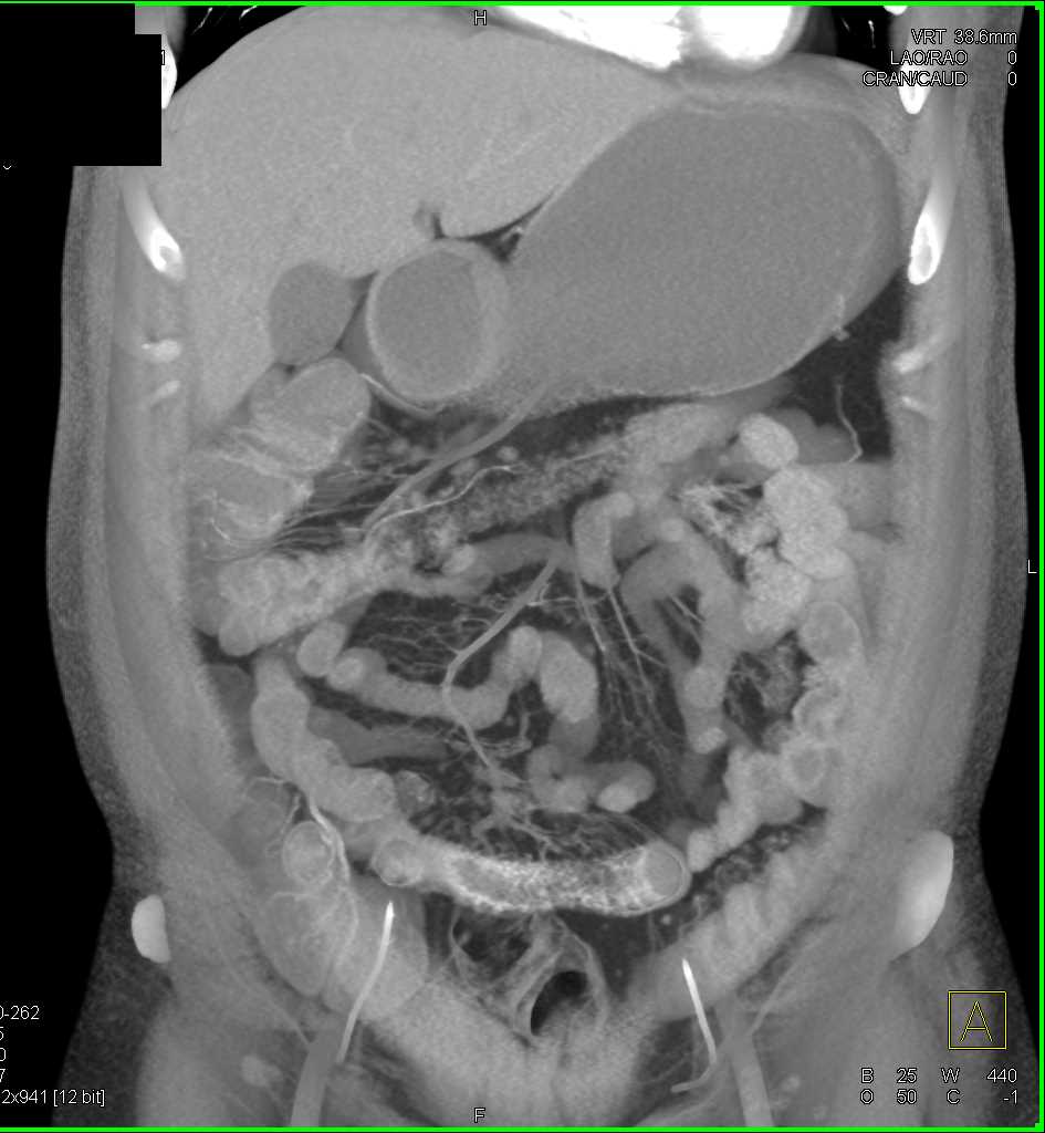 Crohn's Disease terminal Ileum - CTisus CT Scan