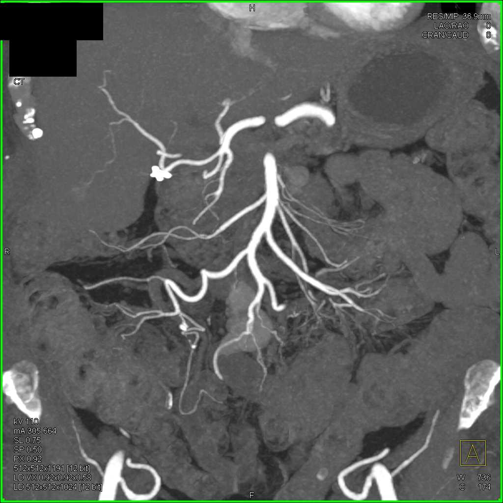 Carcinoid Tumor in Root of Mesentery - CTisus CT Scan