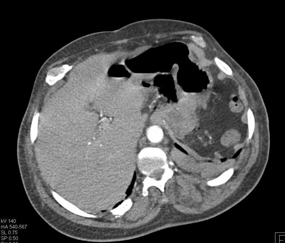 Small Bowel Pneumatosis - CTisus CT Scan