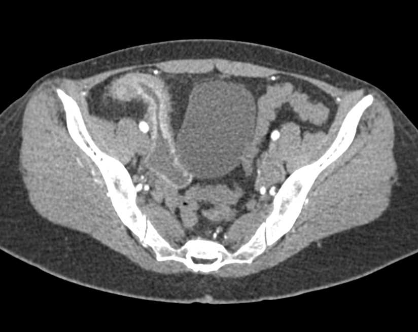 Crohn's Disease Involving the Terminal Ileum - CTisus CT Scan