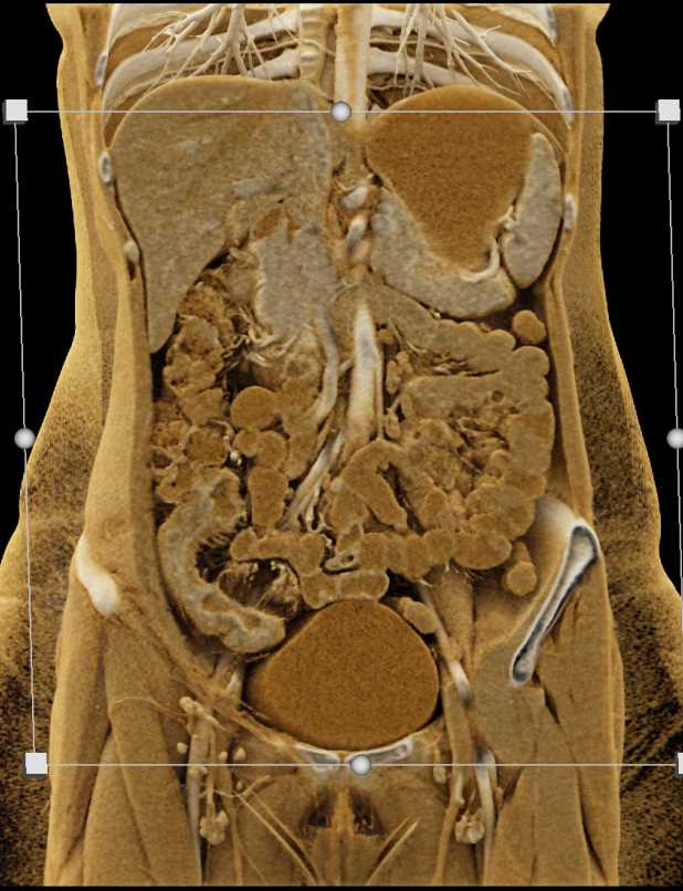 Crohn's Disease Involving the Terminal Ileum with Prominent Enhancement in 3D - CTisus CT Scan