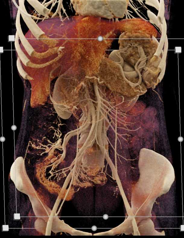 Crohn's Disease Involving the Terminal Ileum with Prominent Enhancement in 3D - CTisus CT Scan