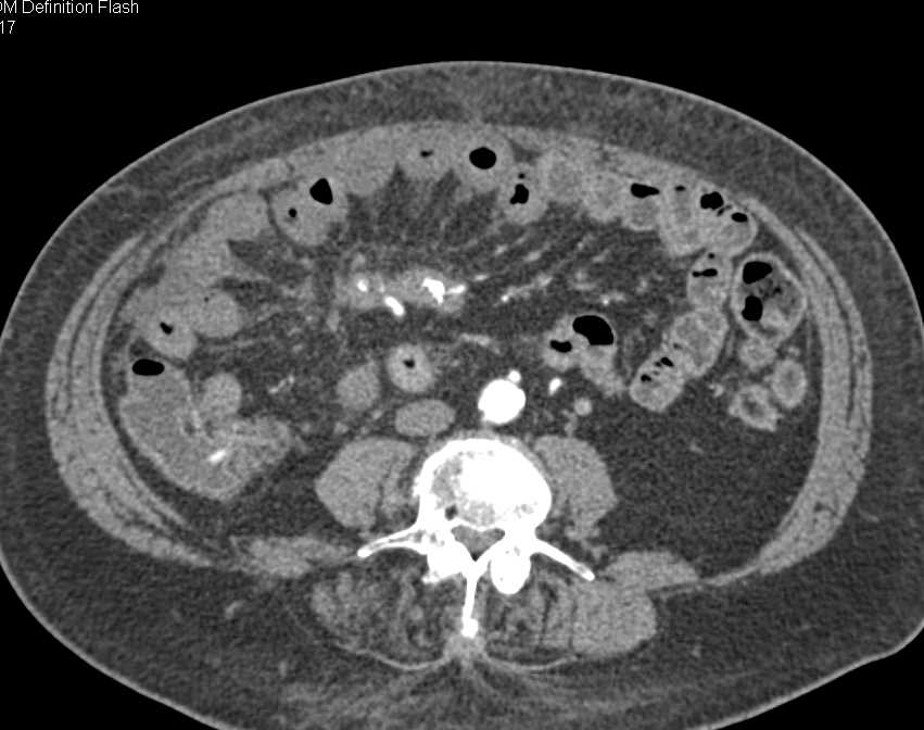 Carcinoid Tumor in the Root of the Mesentery - CTisus CT Scan