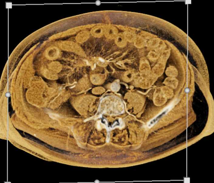 Carcinoid Tumor in the Root of the Mesentery - CTisus CT Scan