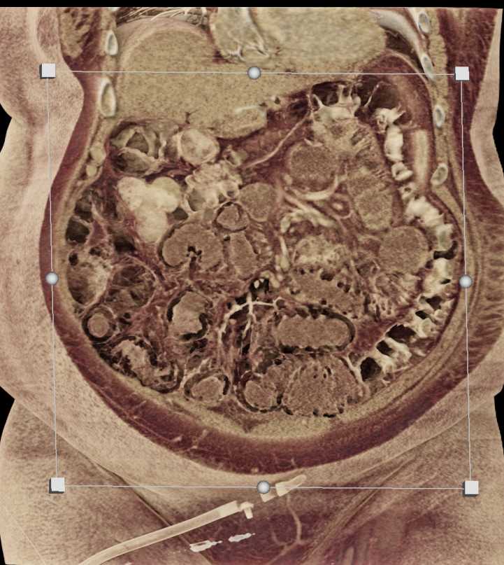 Ischemic Bowel with Pneumatosis - CTisus CT Scan