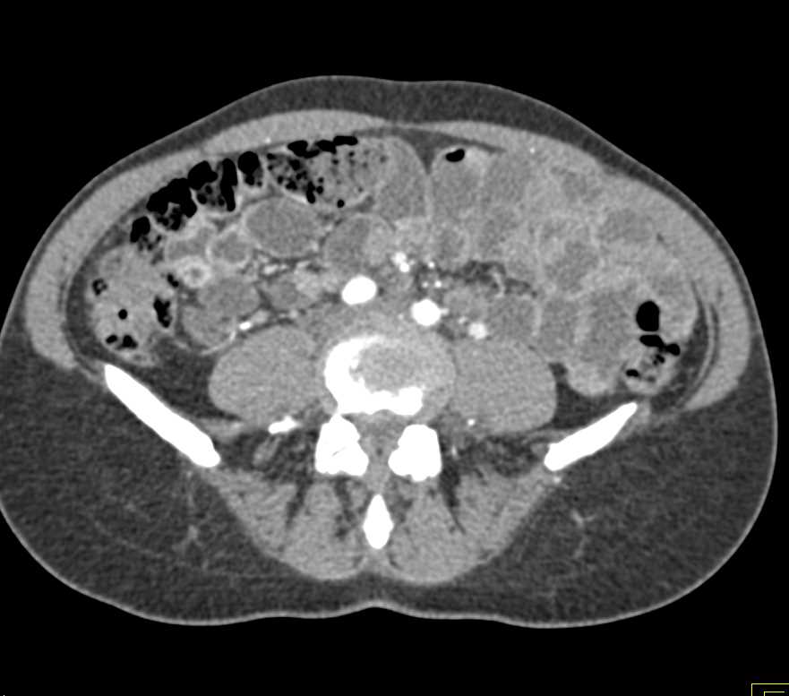 Carcinoid Tumor in the Distal Ileum - CTisus CT Scan