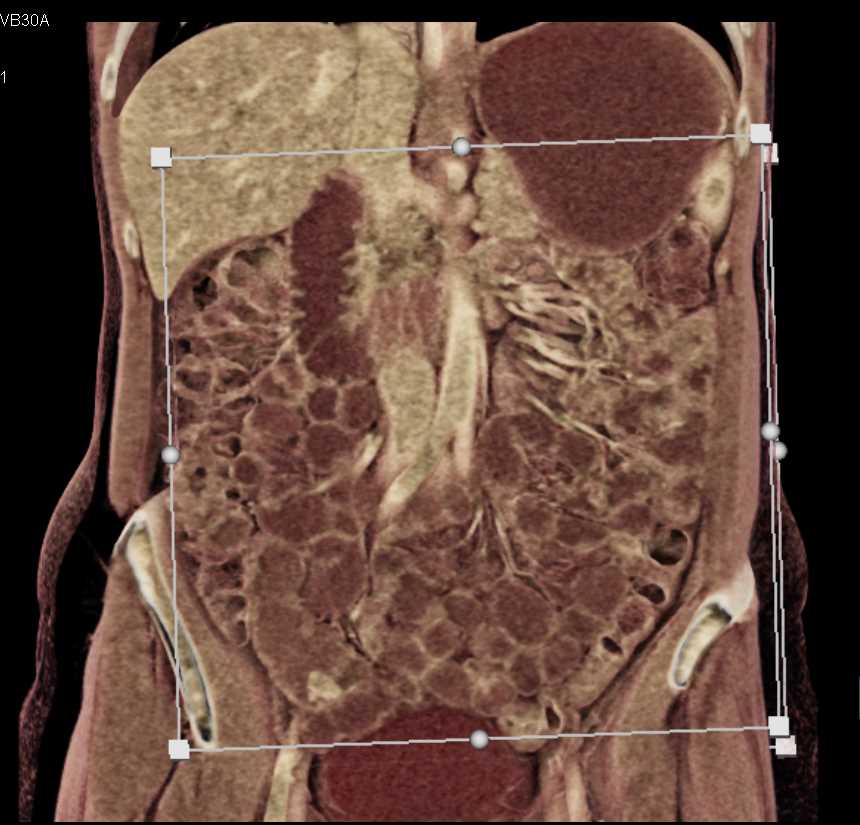 Carcinoid Tumor in the Distal Ileum - CTisus CT Scan