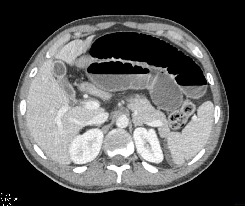 Distal Small Bowel Obstruction - CTisus CT Scan