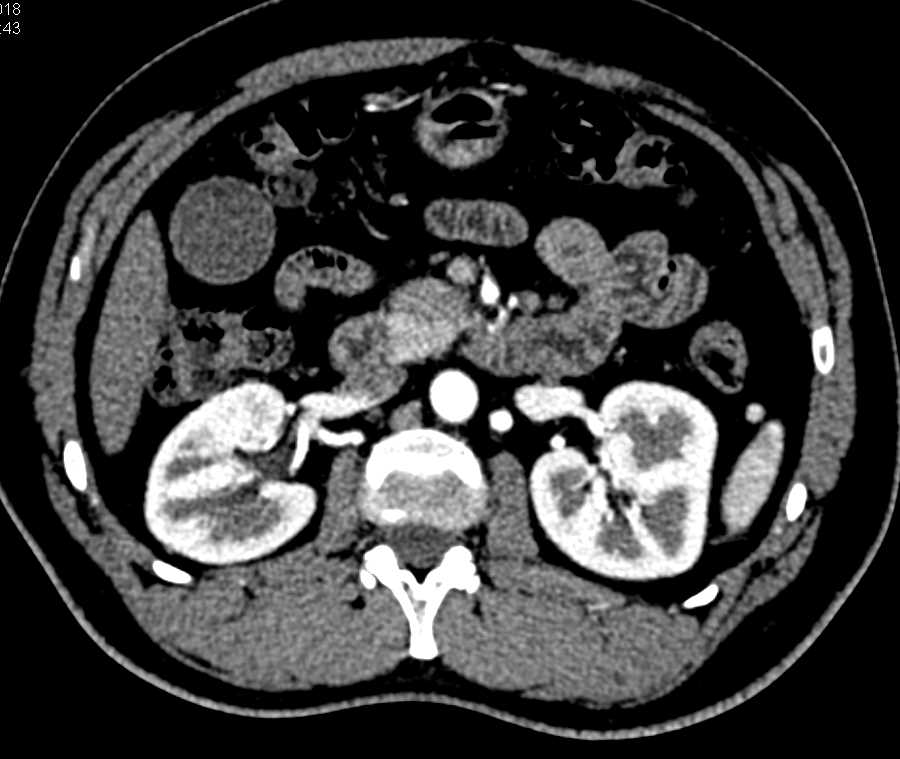 Adenocarcinoma Duodenum 4th Portion - CTisus CT Scan