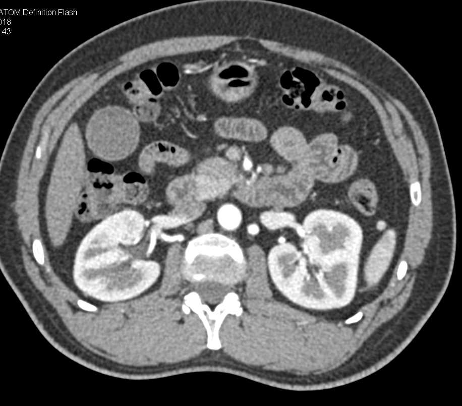 Adenocarcinoma Duodenum 4th Portion - CTisus CT Scan