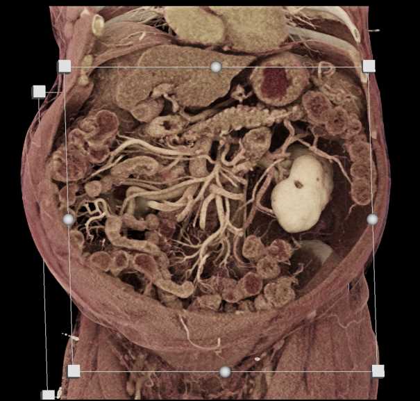 Prominent Mesenteric Arcade - CTisus CT Scan