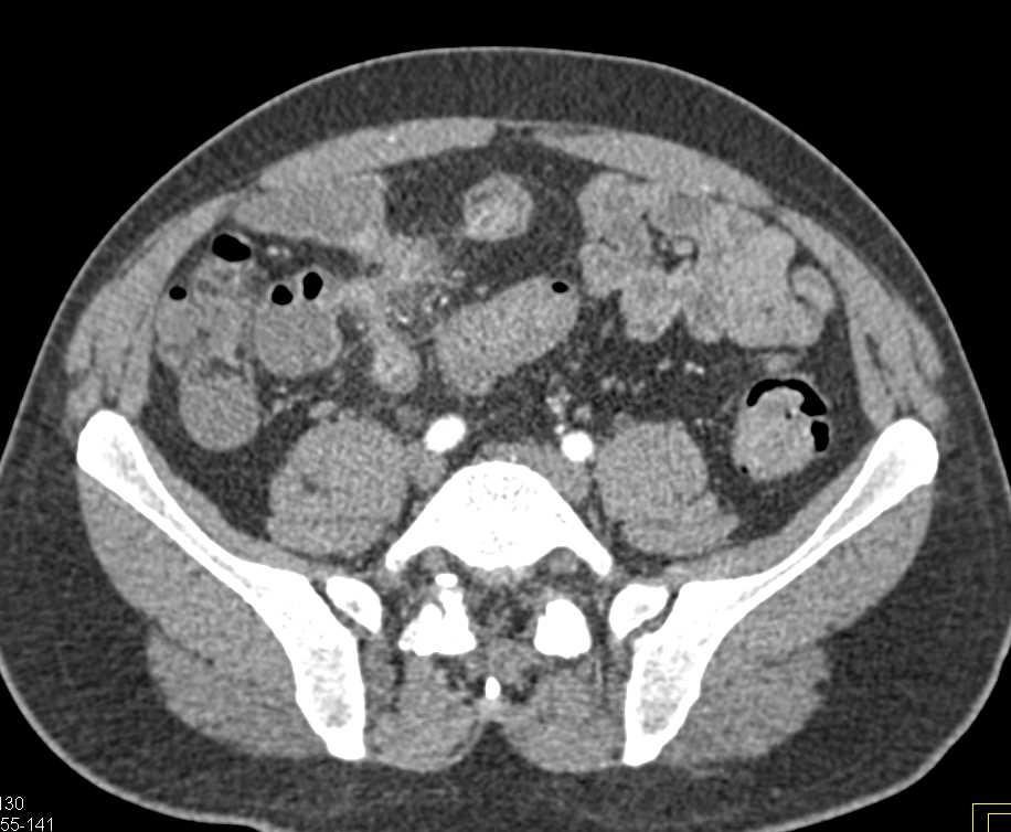 Crohns Disease with Enetero-Enteric Fistulae - CTisus CT Scan