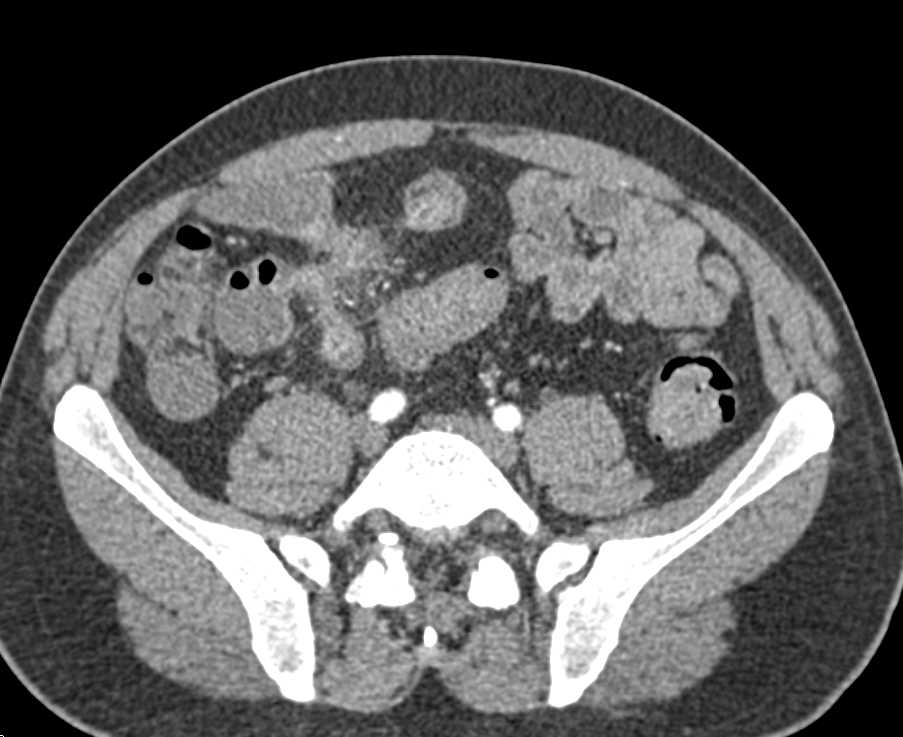 Crohns Disease with Enetero-Enteric Fistulae - CTisus CT Scan