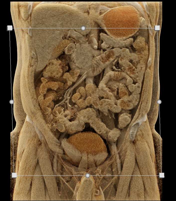 Crohns Disease with Enetero-Enteric Fistulae - CTisus CT Scan