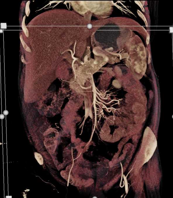 Carcinoid Tumor Root of Mesentery - CTisus CT Scan