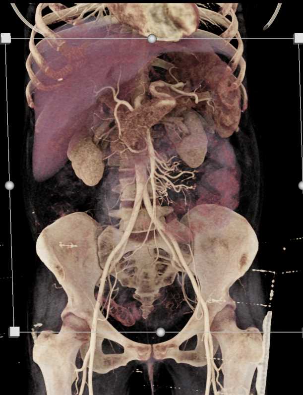 Carcinoid Tumor Root of Mesentery - CTisus CT Scan