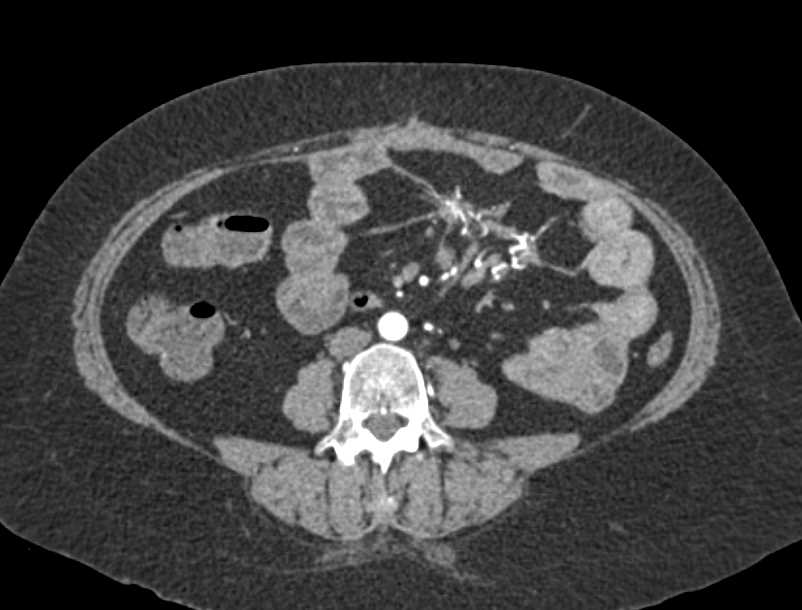 Carcinoid Tumor Root of Mesentery with Desmoplastic Reaction - CTisus CT Scan