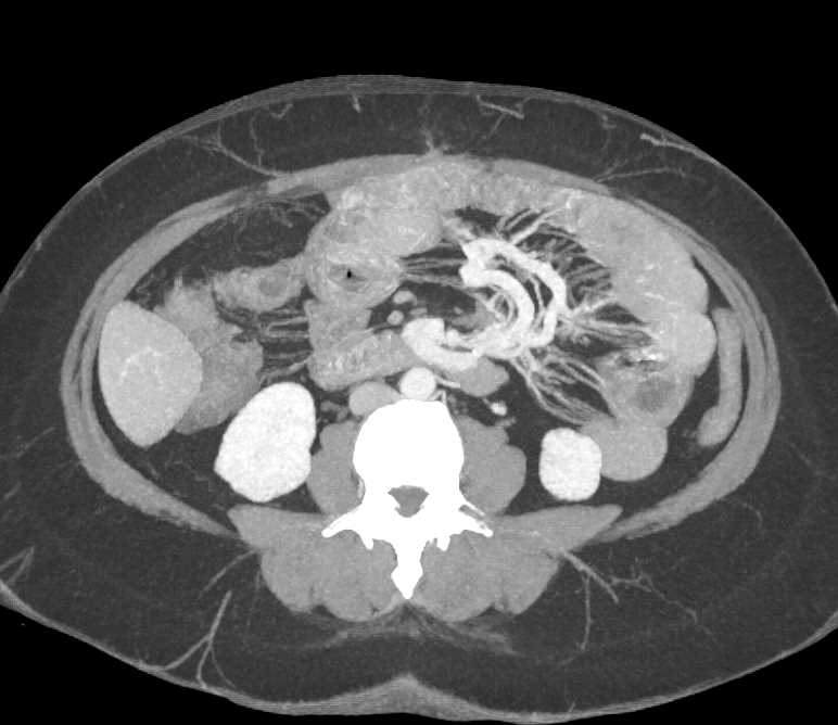 Carcinoid Tumor Root of Mesentery with Desmoplastic Reaction - CTisus CT Scan