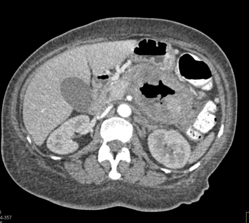 Small Bowel Adenocarcinoma - CTisus CT Scan