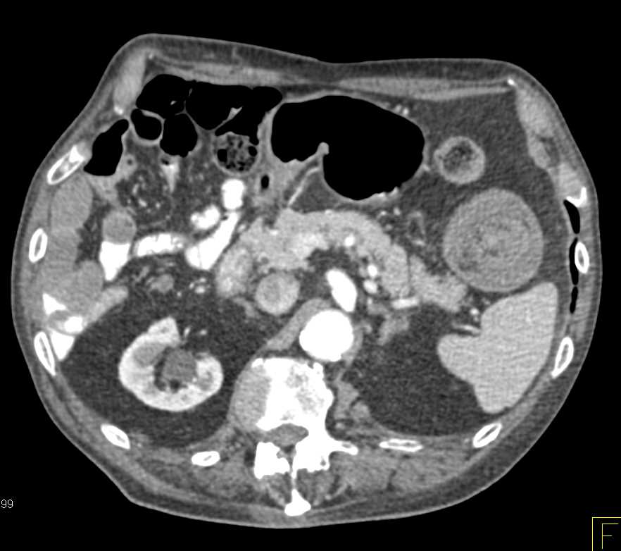 Small Bowel Intussusception Jejunum - CTisus CT Scan