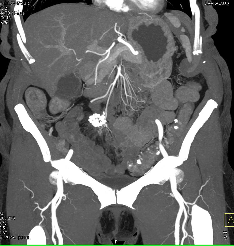 Carcinoid Tumor RLQ is Calcified - CTisus CT Scan