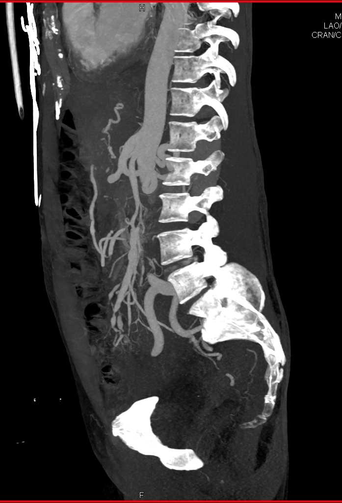 SMA Encasement by Carcinoid Tumor - CTisus CT Scan