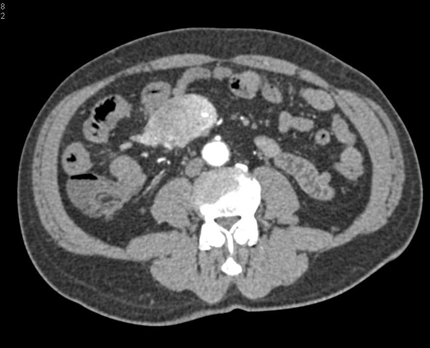 Carcinoid Tumor in the Root of Mesentery - CTisus CT Scan