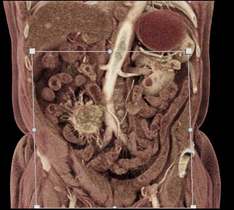 Carcinoid Tumor in the Root of Mesentery - CTisus CT Scan