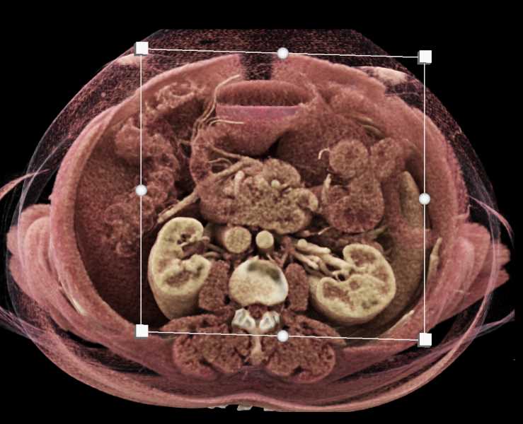Carcinoid Tumor 4th Portion Duodenum - CTisus CT Scan