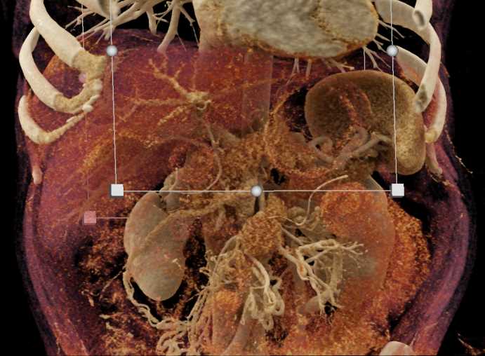 Carcinoid Tumor 4th Portion Duodenum - CTisus CT Scan