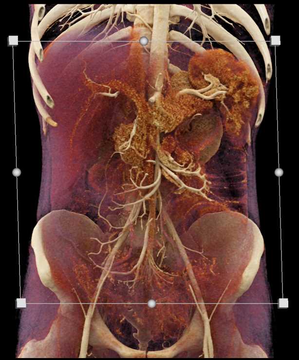 Distal Small Bowel Obstruction - CTisus CT Scan