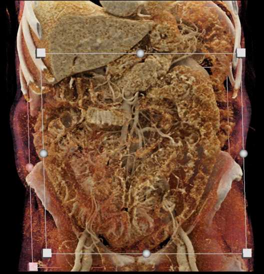 Multiple Neuroendocrine tumors - CTisus CT Scan