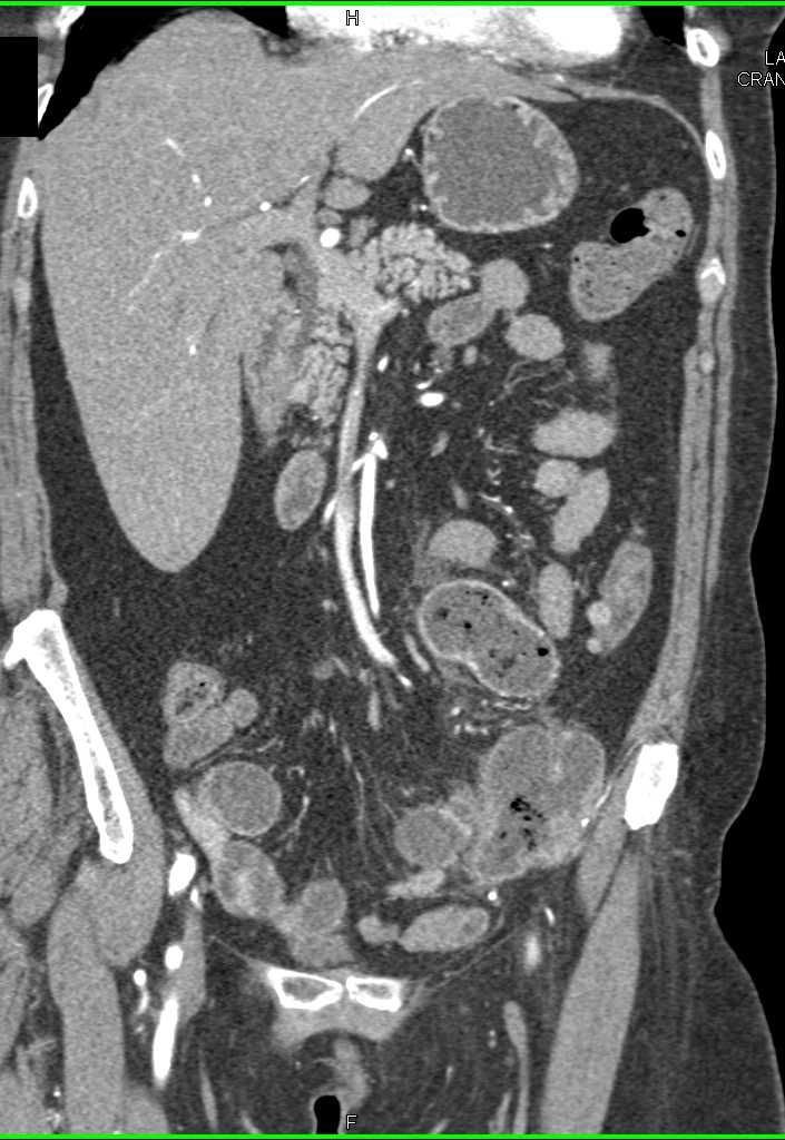 Inflammed Small Bowel with Perforation - CTisus CT Scan