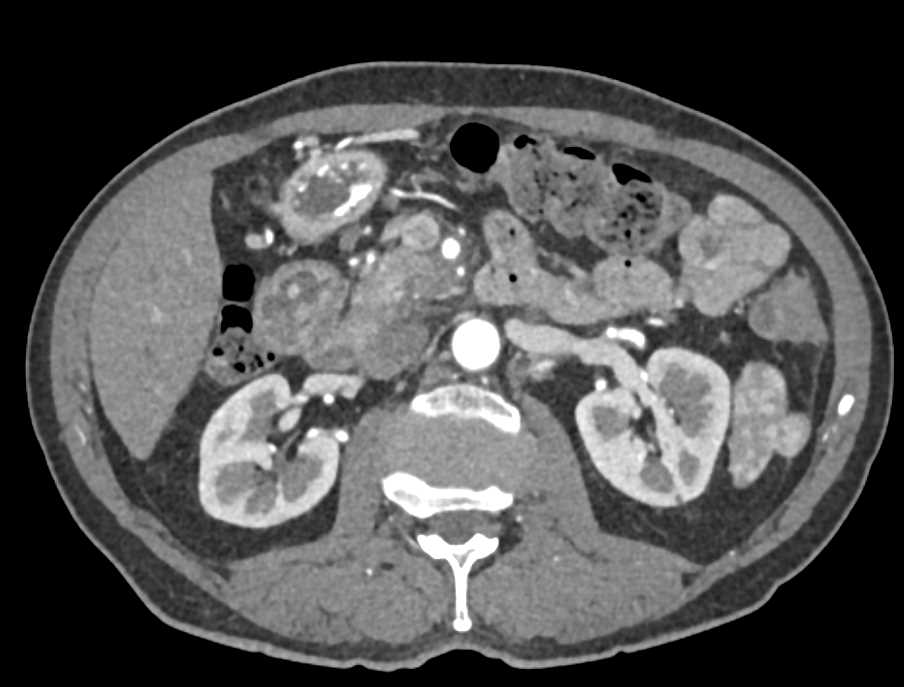 Active Bleed in the Duodenum - CTisus CT Scan