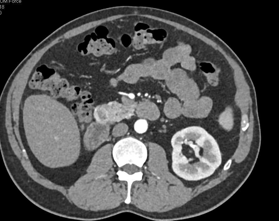 Duodenal GIST Tumor - CTisus CT Scan
