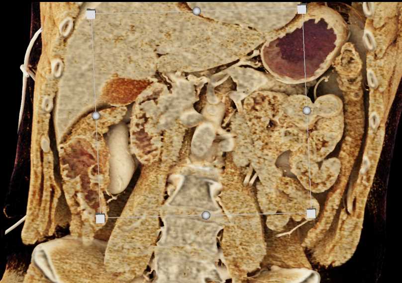 Ampullary Lesion in the Duodenum - CTisus CT Scan