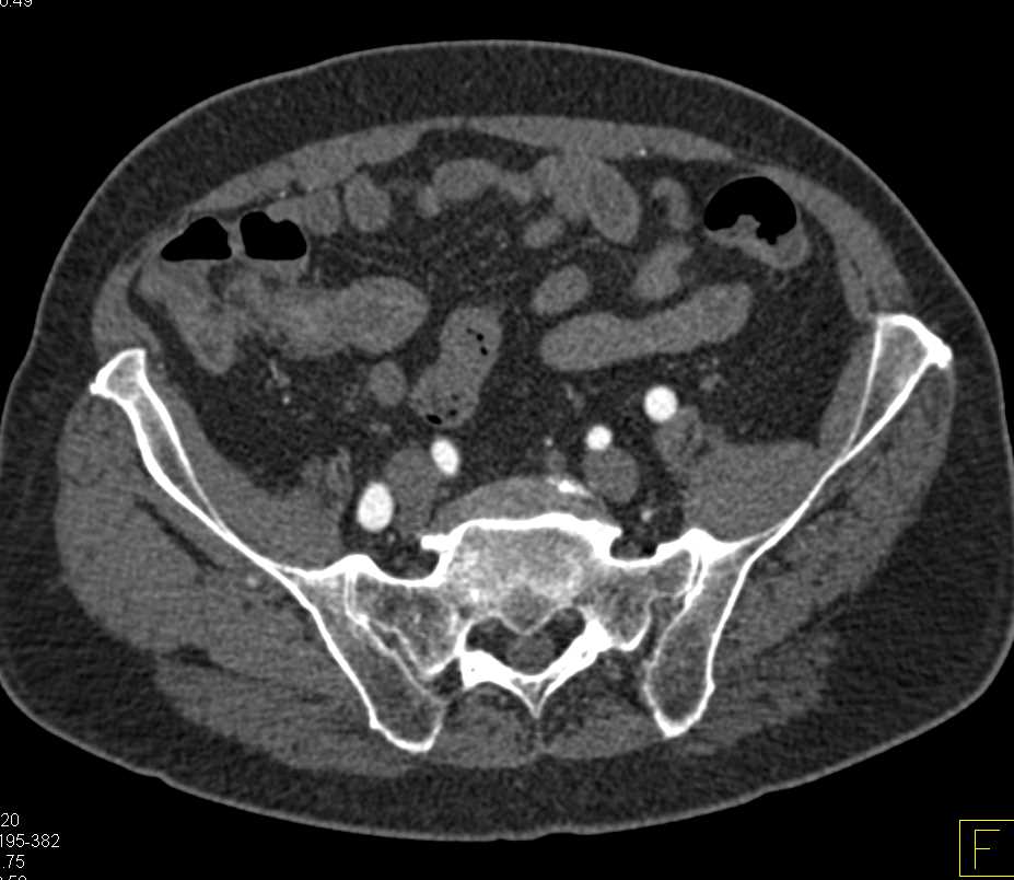 Crohn's Disease Terminal Ileum - CTisus CT Scan