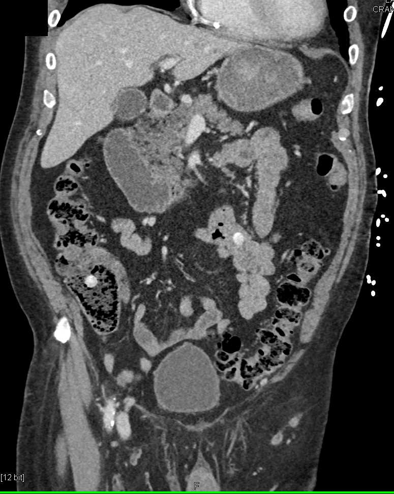 Retained Foreign Matter in the Small Bowel Simulates a Gastrointestinal (GI) Bleed - CTisus CT Scan