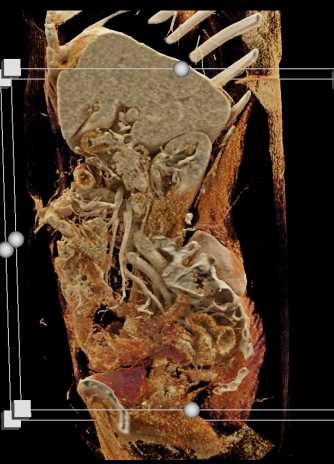 CTA for Gastrointestinal (GI) Bleed is Negative - CTisus CT Scan