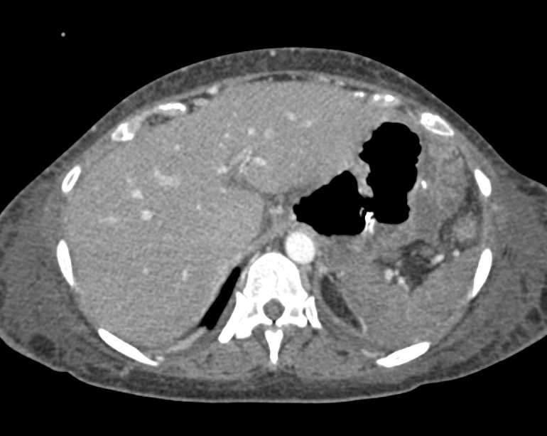 post Op Dehesence of the Rectus Muscle - CTisus CT Scan